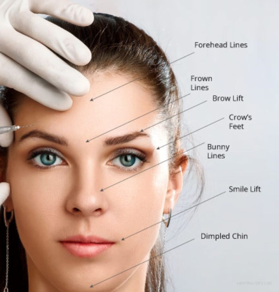 Botox